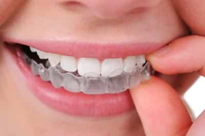 Aligner Invisalign