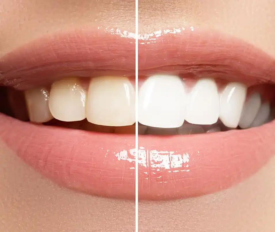 Whitening teeth